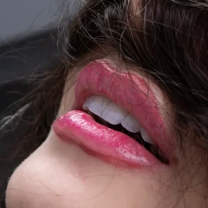کامپوزیت دندان و مراقبت های ان